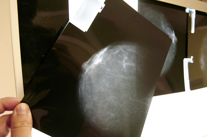 ¿Mamografías a los 40? Nueva pauta para la detección del cáncer de seno genera debate