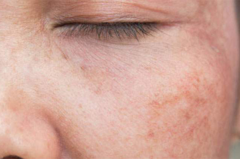 La carencia de vitamina B6 podría causar daños en la piel 