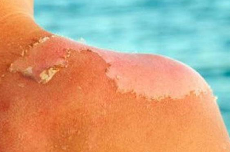Exposición prologanda al sol, aumenta riesgo de cáncer de piel